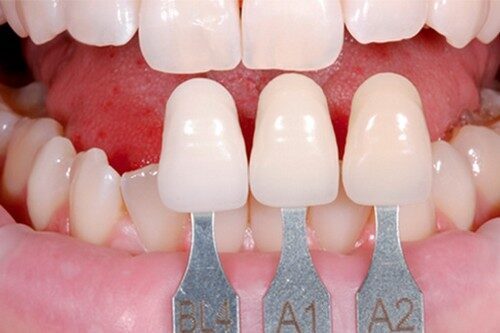 Răng sứ cercon có độ bền bao lâu ? Răng sứ cercon có độ bền bao lâu ?