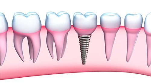 cam ghep rang implant hieu qua cam ghep rang implant hieu qua