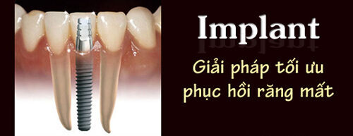 Răng Implantlà một thành tựu khoa học tuyệt vời nhất trong lịch sử nha khoa Răng Implantlà một thành tựu khoa học tuyệt vời nhất trong lịch sử nha khoa