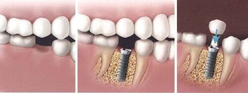 Trong răng implant nhu the nao