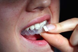 Niềng răng bao lâu ở người lớn Niềng răng bao lâu ở người lớn