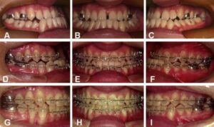 Niềng răng bao lâu ở trẻ em Niềng răng bao lâu ở trẻ em