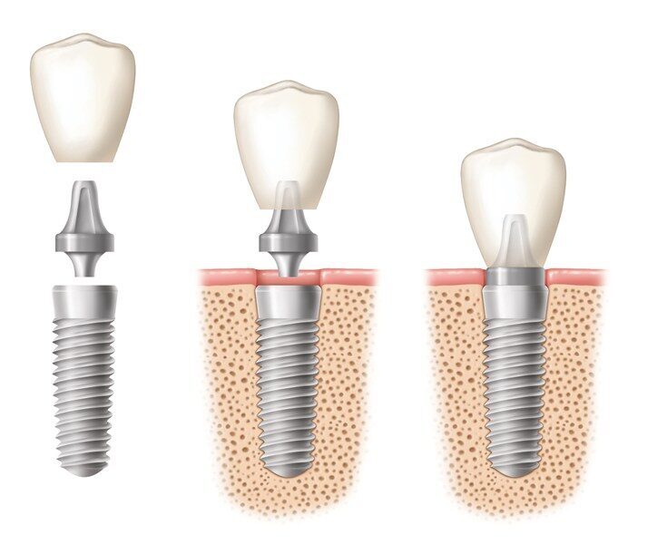 Răng implant là gì ? Tại sao bạn nên sử dụng nó 