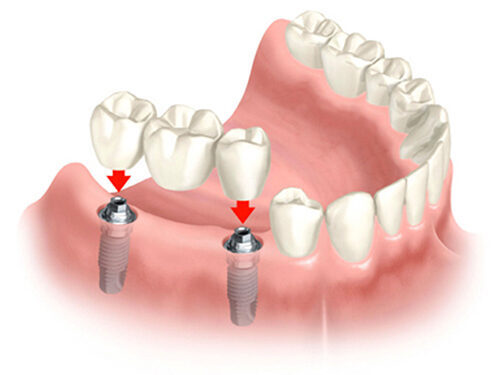 Implant là gì - là giải pháp tối ưu khắc phục việc mất răng