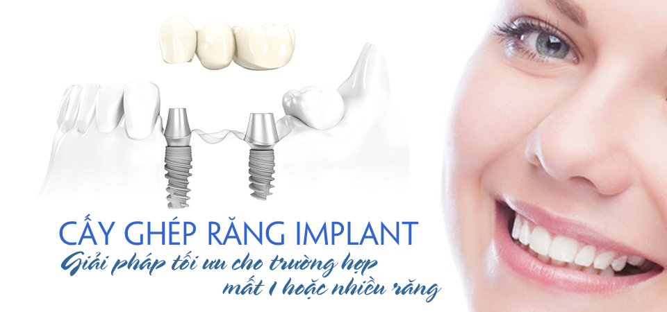 Trồng răng Implant - Giải pháp tốt trong phục hình răng đã mất