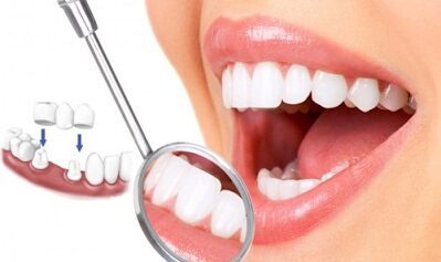 So sánh kỹ thuật bọc răng sứ và mặt dán sứ Veneer So sánh kỹ thuật bọc răng sứ và mặt dán sứ Veneer