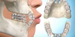 5 video mô phỏng về nắn chỉnh nha có nhổ răng