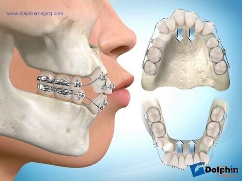 5 video mô phỏng về nắn chỉnh nha có nhổ răng