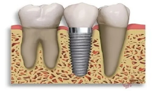 trong rang implant cho tre nen khong trong rang implant cho tre nen khong