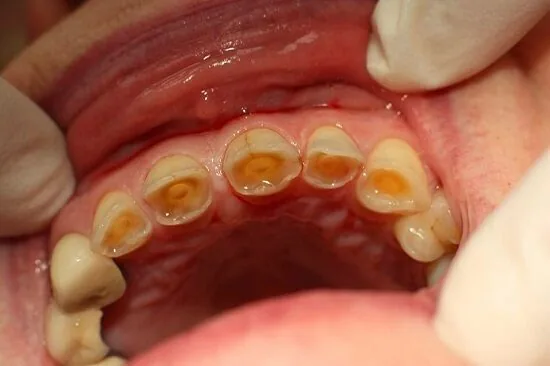 Không phải thuốc hay dụng cụ làm trắng nào cũng phù hợp với mọi loại răng