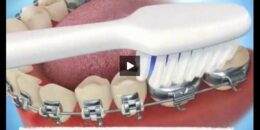 Cách vệ sinh răng miệng khi nắn chỉnh răng