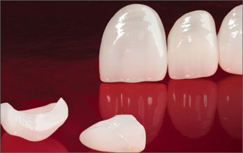 Bác sĩ tư vấn: Có nên bọc răng sứ khi bị sứt răng không?