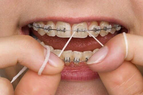 7 dấu hiệu cho thấy bạn cần phải chỉnh nha niềng răng