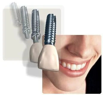 Trong rang implant o dau tot Trong rang implant o dau tot