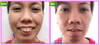 Cac benh can chinh nha nieng rang Cac benh can chinh nha nieng rang