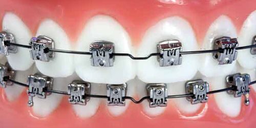 Tại nha khoa Việt Úc niềng răng có đau không ?