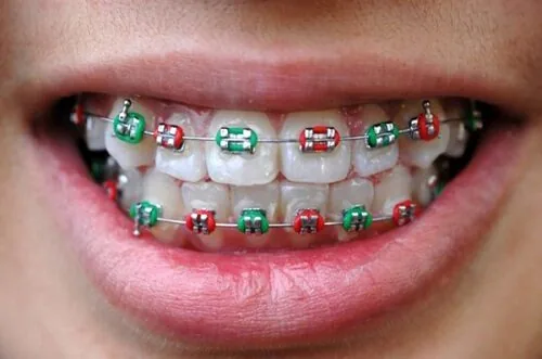 Nha khoa trẻ em- Độ tuổi từ 12-14 là độ tuổi thích hợp để niềng răng nieng-rang-tre-em