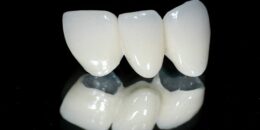 Vì sao răng sứ Cercon được cho là tốt hiện nay?