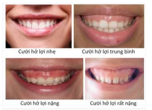 Khắc phục cười hở lợi