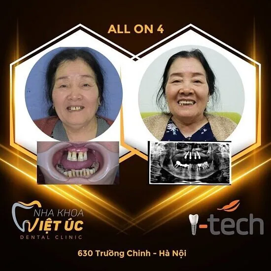 Trong rang Implant All on 4, All on 6