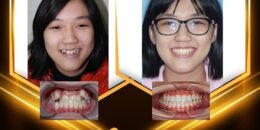 Bác sĩ tư vấn: Niềng răng không nhổ răng có được không?