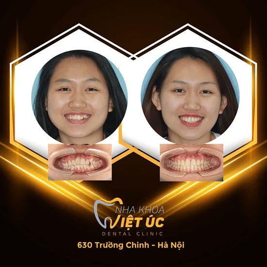 hinh anh benh nhan nieng rang