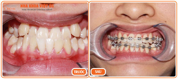 Hình ảnh bệnh nhân niềng răng móm