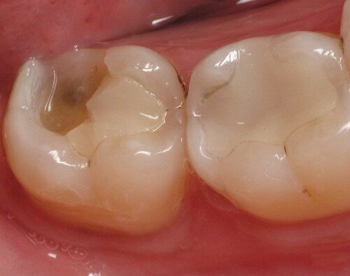 Răng bị sứt như thế nào mới nên bọc răng sứ?