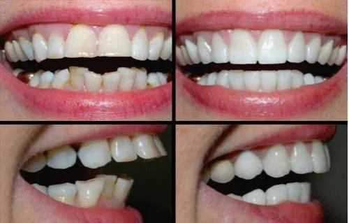 Bọc răng sứ cho răng hô là gì? boc su cho rang ho 1