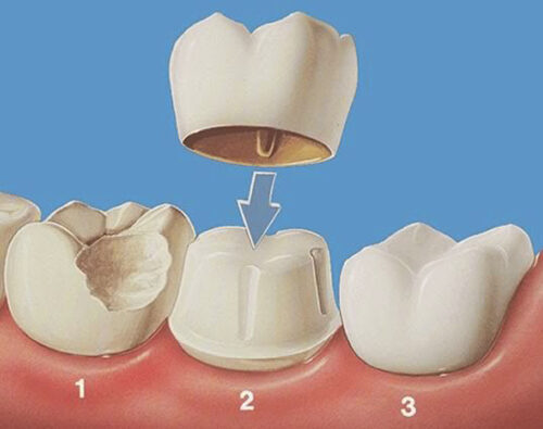 3 câu hỏi giúp giải đáp cho việc bọc răng sứ có tốt không