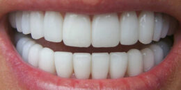 Bọc răng sứ cho răng cửa có khiến hàm bị xô lệch không?