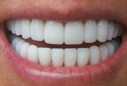 Bọc răng sứ cho răng cửa có khiến hàm bị xô lệch không?