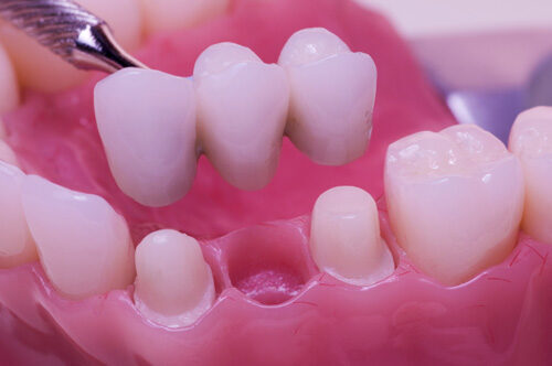Bọc răng sứ có đau không ? Có biến chứng gì sau này không ?