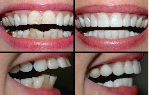 Bọc răng sứ cho răng hô có hiệu quả không? Bọc răng sứ cho răng hô có hiệu quả không?