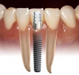 Có nên cắm implant cho trẻ không? trong rang implant cho tre nen khong 1