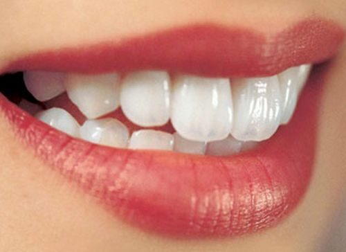 Bọc răng sứ cho răng hô có hiệu quả không
