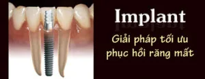 làm răng Implant
