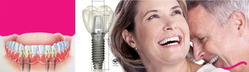 trong rang implant luu y gi trong rang implant luu y gi