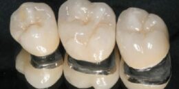 Quy trình bọc răng sứ Titan đúng chuẩn quốc tế như thế nào?