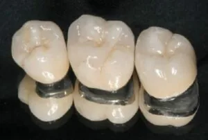 Quy trình bọc răng sứ Titan kéo dài trong bao lâu? Quy trình bọc răng sứ Titan kéo dài trong bao lâu?