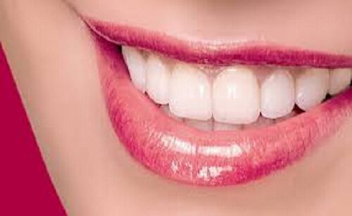 Khi nào nên bọc răng sứ cho răng hàm và tuổi thọ răng đã bọc sứ?