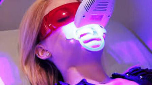 giá tẩy trắng răng bằng công nghệ Laser Whitening