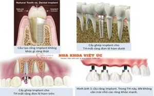 Cấy ghép Implant