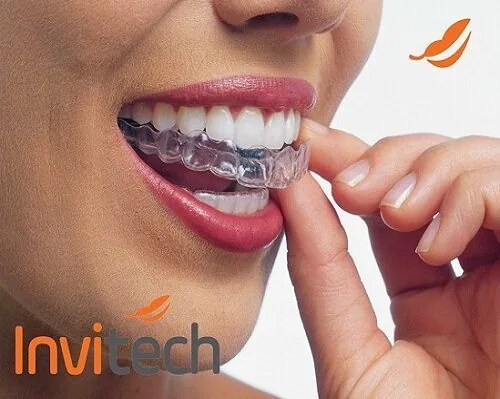 Niềng răng giá bao nhiêu