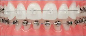 Sự khác biệt của niềng răng mắc cài sứ