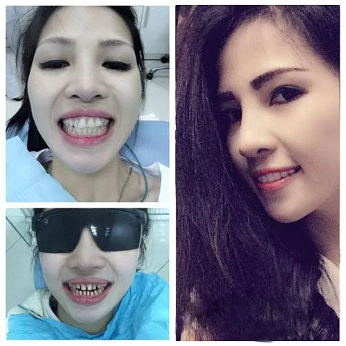 thoi gian cho mot ca boc rang su 2 thoi gian cho mot ca boc rang su 2