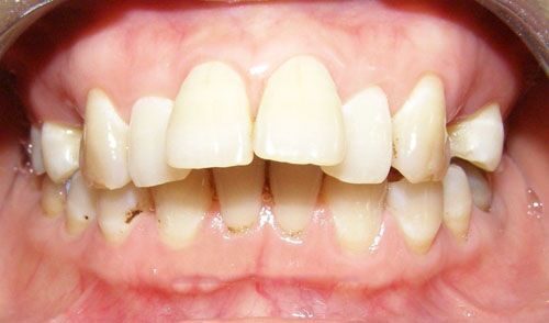 Bọc răng sứ cho răng hô có hiệu quả không?