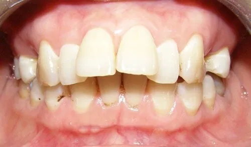 Bọc răng sứ cho răng hô có hiệu quả không? Bọc răng sứ cho răng hô có hiệu quả không?