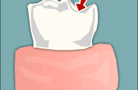 Trám răng inlay – onlay