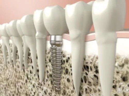 Cay ghep rang implant nha khoa Cay ghep rang implant nha khoa